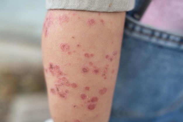 Maladie de la main, du pied et de la bouche une éruption cutanée de cloques douloureuses et une éruptions cutanée écailleuse sèche sur la jambe de l'enfant