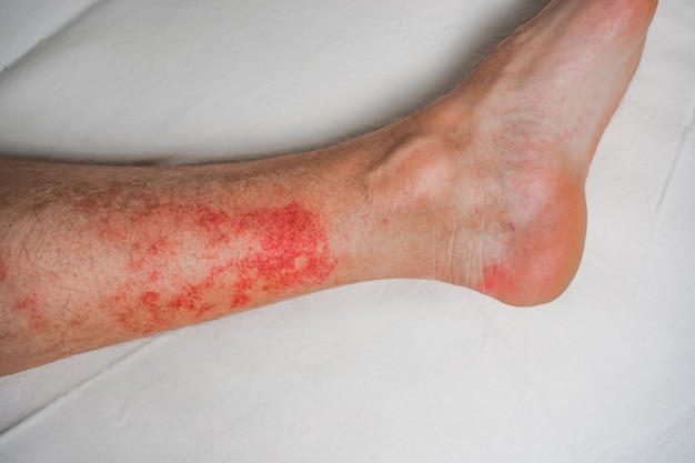 Maladie de la peau eczéma sur les jambes éruptions cutanées et taches rouges qui démangent