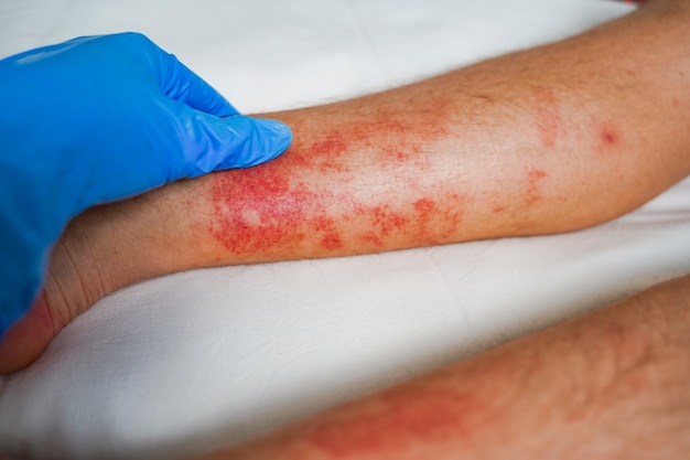 Maladie de la peau eczéma sur les jambes éruptions cutanées et taches rouges qui démangent