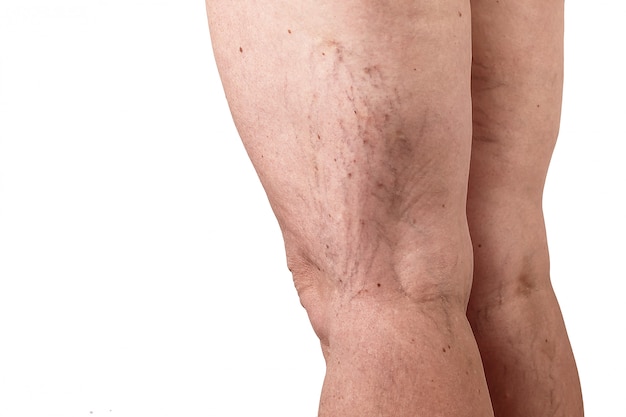 La maladie des varices sur les jambes d'une femme. fond blanc