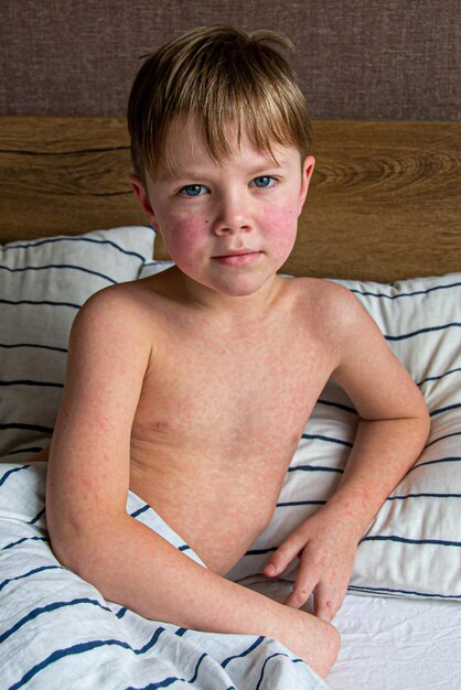 Photo maladie virale rougeole éruption cutanée sur le corps de l'enfant allergie