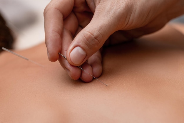 Une masseuse effectue de l'acupuncture sur une fille sur une table de massage