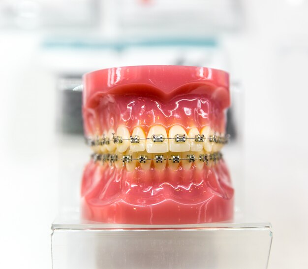 Matériel dentaire, orthodontie, gros plan de prothèse