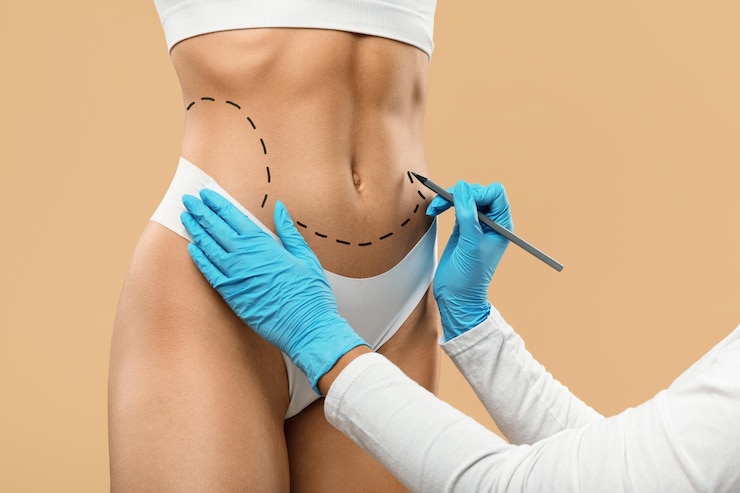Photo médecin dessinant des lignes pointillées sur le corps féminin avant une opération de chirurgie plastique