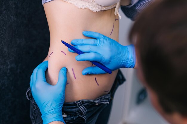 Médecin dessinant des lignes sur le ventre de la femme avec un marqueur Plastic Sur