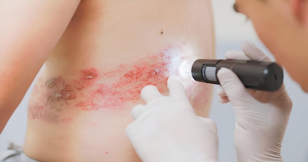 Photo le médecin examine la maladie du zona