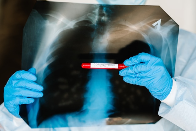 Médecin spécialiste en médecine pulmonaire tenant un film radiologique radiographique du thorax pour le diagnostic médical sur la santé des patients sur un coronavirus infecté. Une main tient un tube à essai avec du sang biologique.