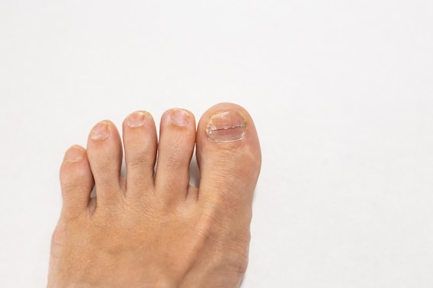 Métal sur les ongles des pieds Podiatre travail pédicure couverture en acier Traitement des ongles incarnés