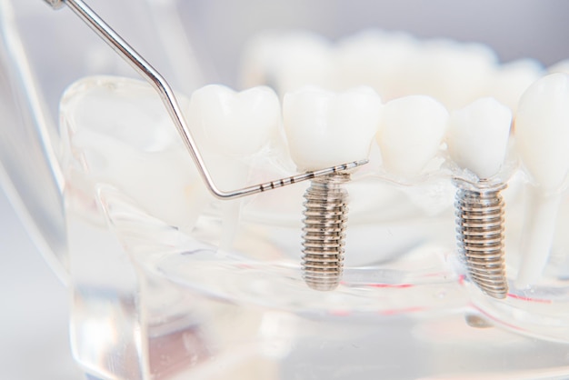 Un modèle de dents avec implants se trouve sur une table