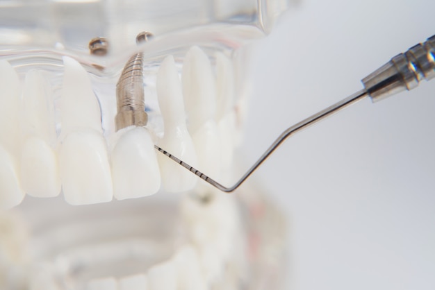 Un modèle de dents avec implants se trouve sur une table