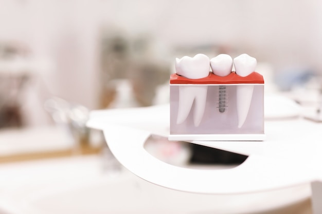 Modèle d'enseignement des dents dentaires dentiste montrant la vis d'implant dentaire en métal titane.