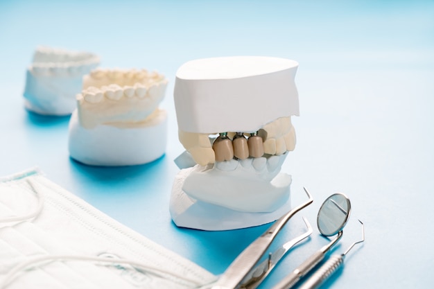 Modèle D'implant Et De Prosthodontie.