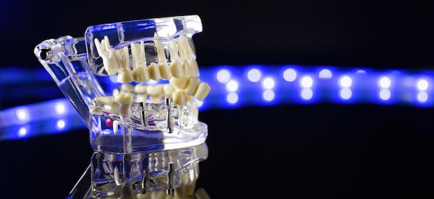 Photo modèle de mâchoire dentaire sur fond noir gouttières ou accolades dentaires invisibles transparentes applicables pour un traitement dentaire orthodontique
