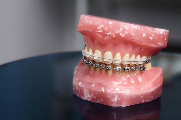 Modèle de mâchoire ou de dents humaines avec des appareils dentaires métalliques