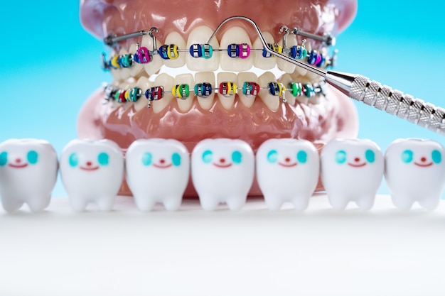 Modèle orthodontique et outil de dentiste - modèle de dents de démonstration des variations de la parenthèse ou du corset orthodontique