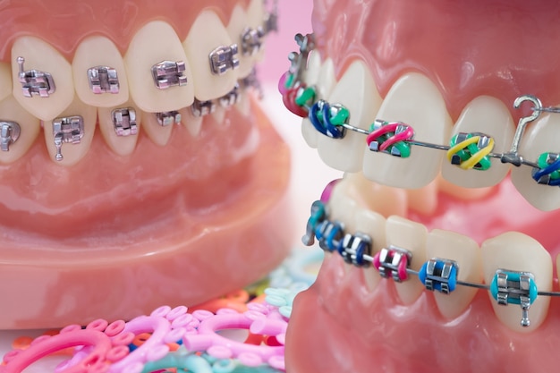 Modèle orthodontique et outil de dentiste - Modèle de dents de démonstration de variétés de brackets ou orthèses orthodontiques