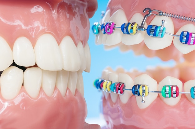 Modèle orthodontique et outil de dentiste - Modèle de dents de démonstration de variétés de brackets ou orthèses orthodontiques