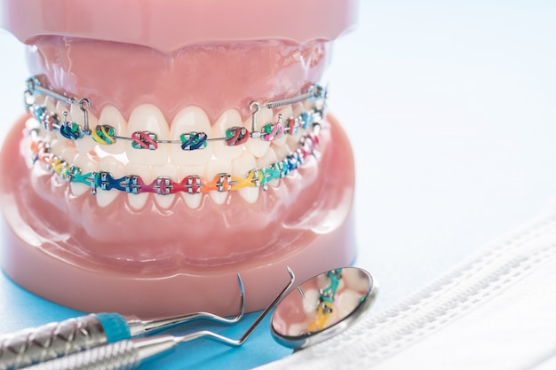 Modèle orthodontique et outil de dentiste - modèle de dents de démonstration des variétés de brackets orthodontiques