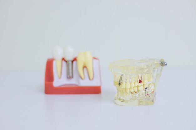 Modèle orthodontique et outil de dentiste - modèle de dents de démonstration de variétés de brackets ou de supports orthodontiques.