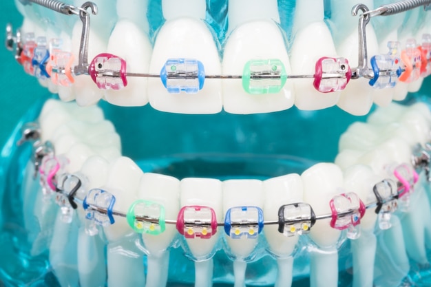 Modèle orthodontique et outil de dentiste - modèle de dents de démonstration de variétés d&#39;orthodontie