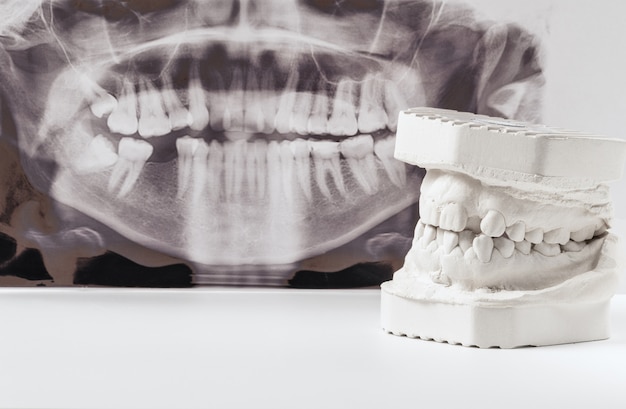 Photo modèle de plâtre dentaire de mâchoires humaines avec radiographie dentaire panoramique