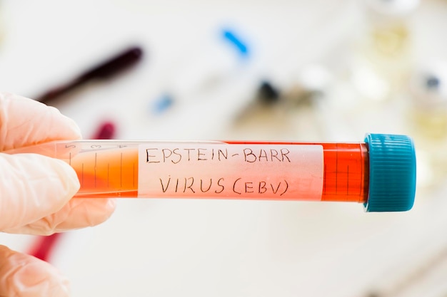 Photo mononucléose et échantillon de test sanguin du virus epstein-barr en laboratoire sur le fond blanc