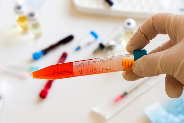 Photo mononucléose et échantillon de test sanguin du virus epstein-barr en laboratoire sur le fond blanc