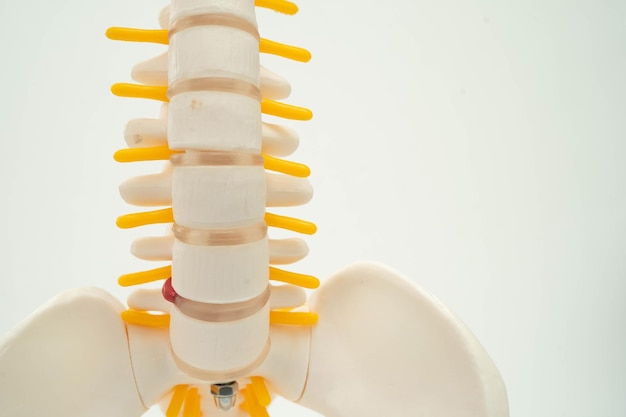 Nerf rachidien et os Colonne lombaire déplacée Fragment de hernie discale Modèle pour le traitement médical dans le service orthopédique