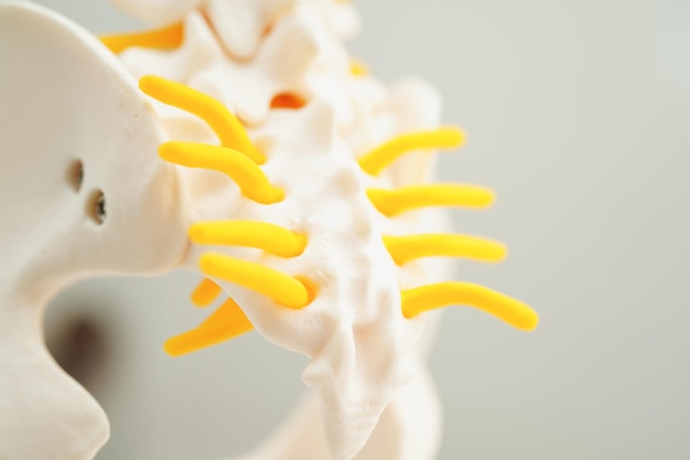 Nerve épinière et osseux Fragment de disque herniaire déplacé de la colonne vertébrale lombaire Modèle de traitement médical