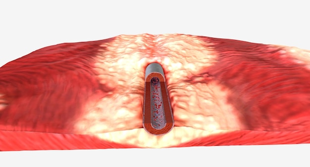 Photo les niveaux élevés de potassium hyperkaliémie