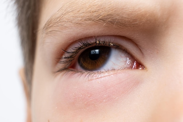 Oeil d'un enfant atteint de conjonctivite inflammation de la conjonctive agrandi