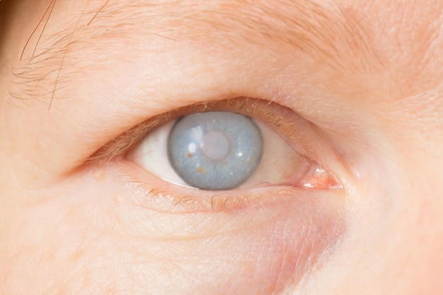 Oeil féminin avec cataracte