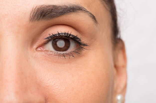 Oeil de jeune fille avec cataracte