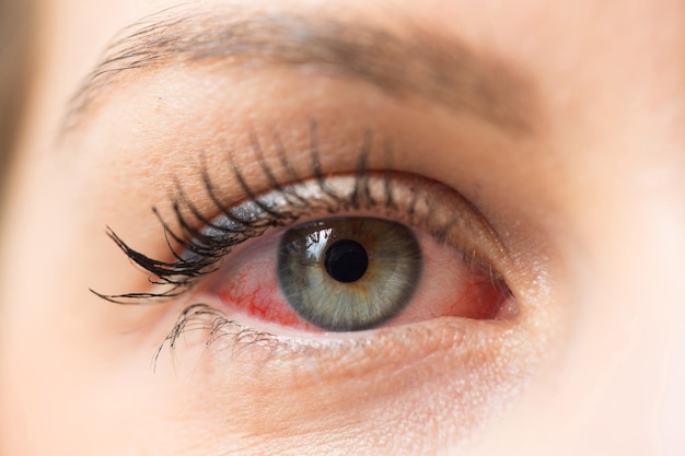 Oeil rouge humain pour allergie