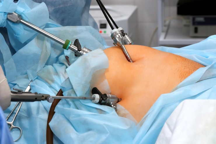 Photo opération de l'estomac procédure médicale de traitement d'un patient par intervention chirurgicale en salle d'opération