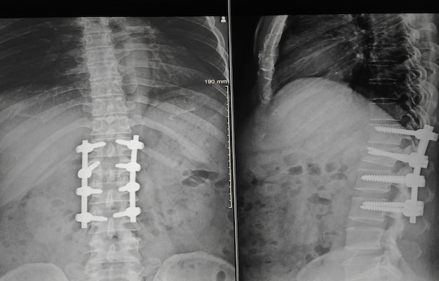 Opération de post-exposition de rayon-X Laminectomy avec la vis de plat