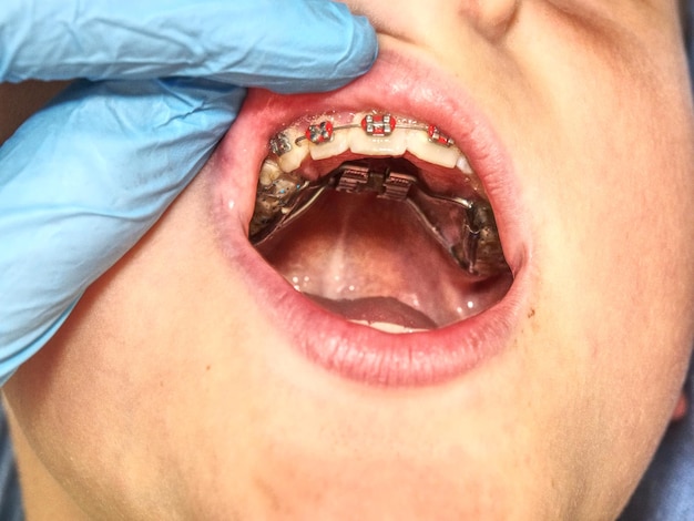 Orthèses palataires pour la correction des défauts de naissance macro des dents avec des orthèses traitement orthodontique