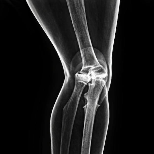 Photo osteoarthrite x-ray du genou gauche ap l'avant et l'arrière du genou montrent un espace articulaire étroit