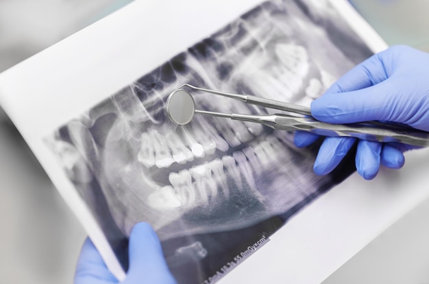 Outils dentaires avec placages sur fond blanc Concept de technologie médicale Hygiène dentaire Cure conc