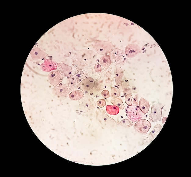 Photo pap smear smear inflammatoire avec des modifications liées au hpv cancer du col de l' utérus scc