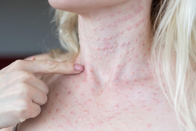 Papules après des injections de beauté sur le visage. Gros plan photo