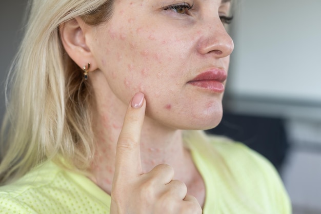 Papules après des injections de beauté sur le visage. Gros plan photo