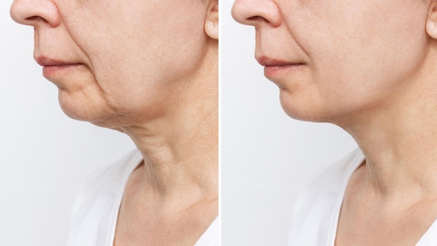 La partie inférieure du visage et du cou d'une femme âgée présentant des signes de vieillissement cutané avant et après le lifting