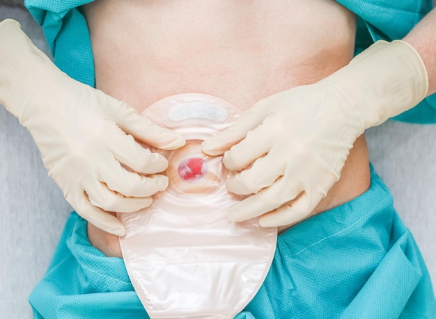 Photo un patient en pyjama avec un abdomen ouvert dépassant de l'intestin avec un sac de colostomie