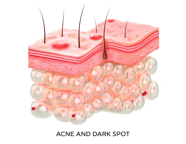 Peau avec acné Illustration 3d de la structure de la microstructure des couches de peauImages médicales et éducatives isolées