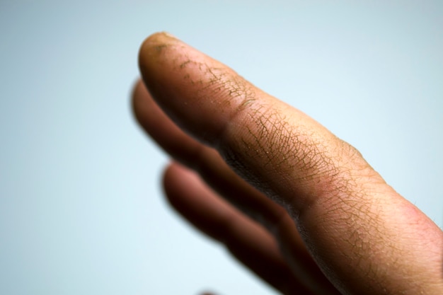 Peau déshydratée et craquelée extrêmement sèche d'une main d'homme avec des fragments d'épiderme qui exfolient ...
