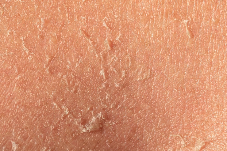 Photo peeling et l'écaillement de la peau d'une personne d'âge moyen est vu de près la peau malsaine