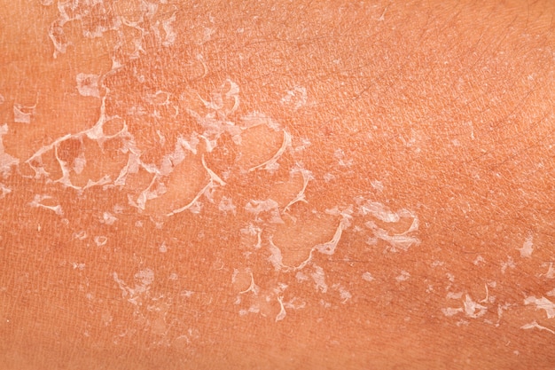 Peeling de la peau après brûlé par la lumière du soleil