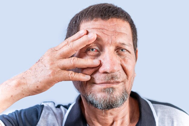 Personne âgée avec des yeux irrités Homme âgé avec des douleurs oculaires isolé Vieil homme avec une conjunctivite sur fond blanc