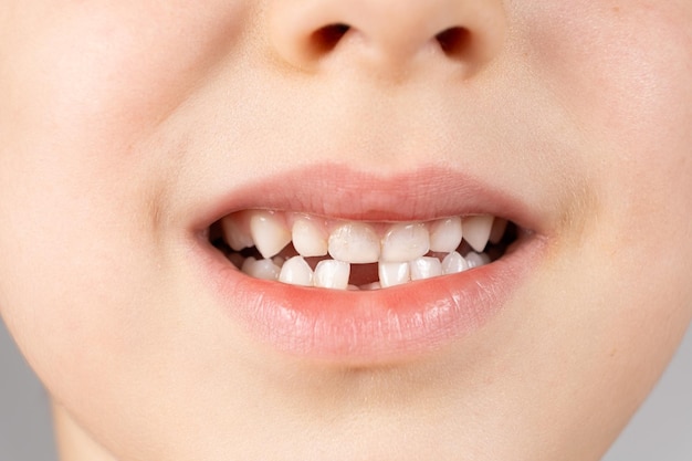 Perte des dents de lait chez les enfants Un enfant de six ans montre la première dent de lait qui lui est tombée